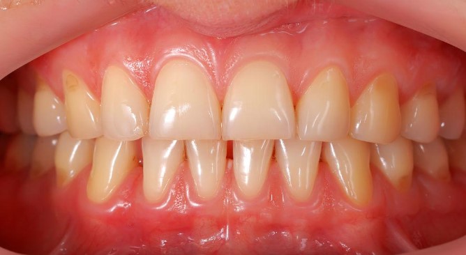 Why You Need to Pay Attention to Your Gums